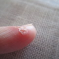 小指の湿疹