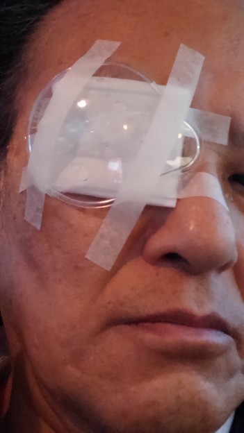 写真: 白内障手術で眼内レンズ挿入