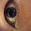 写真: 術後の目。変わらん。