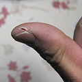写真: 親指のひび割れ